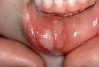 Причини виникнення стоматиту у дітей thumbnail