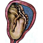 Двс синдрома преждевременная отслойка плаценты thumbnail