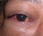 Воспаление мышцы глаза лечение thumbnail