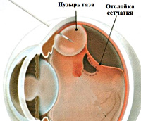 Пневморетинопексия при отслойке сетчатки