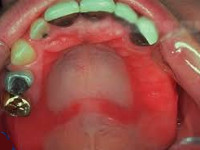 Аллергия к материалам применяемых в ортопедической стоматологии thumbnail