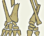 Перелом костей со смещением отломков thumbnail