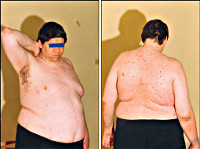 Гипоталамический синдром на фоне ожирения thumbnail
