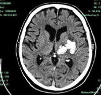 Внутримозговая гематома (Интрапаренхиматозная гематома головного мозга) thumbnail