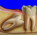 Лечение дистопированный зуб что это thumbnail