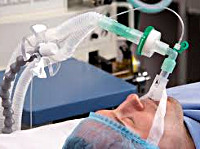 Нозокомиальная пневмония вентилятор ассоциированная пневмония thumbnail