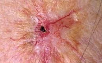 Лучевой дерматит возникает через год после облучения thumbnail