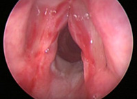 Гематома в полости рта: причины, симптоматика явления и способы лечения thumbnail