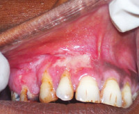 Туберкулез полости рта 