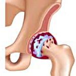 Коксартроз тазобедренного сустава диагностика симптомы и лечение thumbnail