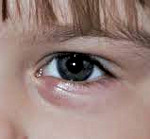 Хронический ячмень на глазу у ребенка thumbnail