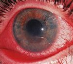 Заболевание глаз иридоциклит и его лечение thumbnail