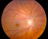 Окклюзия центральной артерии сетчатки глаза что это thumbnail