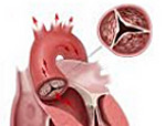 Синдром стенокардии при аортальном стенозе thumbnail