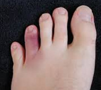 Детский перелом пальца ноги thumbnail