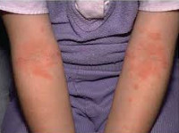 Детям с атопическим дерматитом показано thumbnail