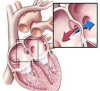 Врожденный порок сердца инфаркт миокарда thumbnail