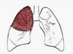 Описание легких при нижнедолевой пневмонии thumbnail