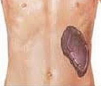 Синдром фелти при ревматоидного артрита thumbnail