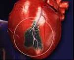 Как развивается инфаркт миокарда thumbnail