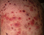 Криоглобулинемия при гепатите с фото thumbnail