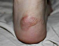 Пузырчатая мозоль на ноге thumbnail