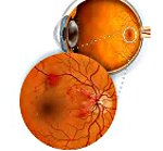 Ретинопатия глаз сетчатки глаза thumbnail
