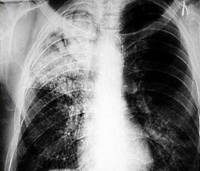 Отрицательная реакция на туберкулин у больных с казеозной пневмонией thumbnail