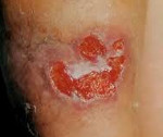 Туберкулез кожи элементы сыпи thumbnail