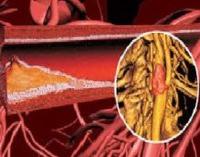 Атеросклероз грудной аорты коронарных артерий thumbnail