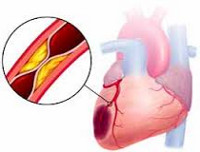 Поражение сердечной мышцы при инфаркт миокарда thumbnail