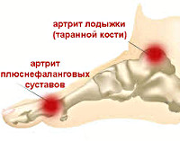 Артрит стопы: симптомы и лечение thumbnail