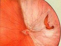 Отслойка сетчатки глаза этиология thumbnail