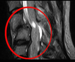 Ушиб спинного мозга (Контузия спинного мозга) thumbnail