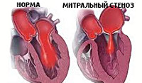 Ревматическая болезнь сердца стеноз митрального клапана thumbnail