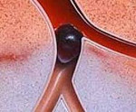 Тромбоз воротной вены как осложнение цирроза печени thumbnail
