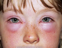 Какие признаки аллергии на животных thumbnail