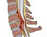 Синдром сдавления спинного мозга лечение thumbnail