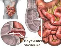 Баугинит симптомы лечение народными средствами thumbnail