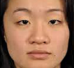 Азиатский разрез глаз лечение thumbnail