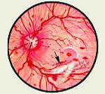 Вторичная глаукома при диабетической ретинопатии thumbnail