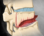 Перелом тела поясничного отдела позвоночника thumbnail