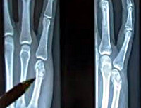 Перелом первой пястной кости руки thumbnail