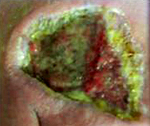 Пневмония, вызванная синегнойной палочкой thumbnail