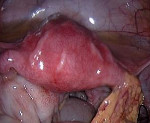Киста яичника или тубоовариальный абсцесс thumbnail
