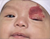 Гемангиома на лице у ребенка 5 лет thumbnail
