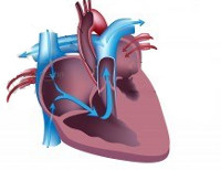 Синдром гіпоплазії лівих відділів серця thumbnail