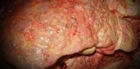 Хронический аутоиммунный гепатит 2 типа thumbnail