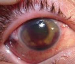 Как вылечить туберкулез глаз thumbnail