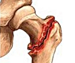 Вколоченный перелом на костях конечностей thumbnail